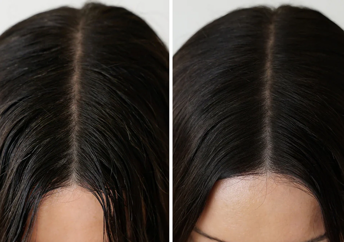 The Biochemistry of Greasy Hair!